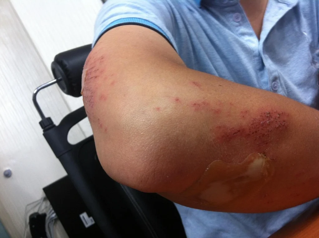 pain journal after a car accident